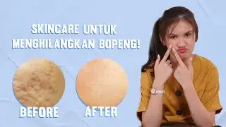 Cara Menghilangkan Bopeng Bekas Jerawat dengan Skincare Ampuh Ini!