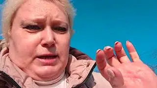 Контрактура Дюпюитрена.Лечу ладошку Чем и как.Киев