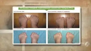 фиксатор вальгус про отзывы

  - Valgus Pro - против шишек на ногах.