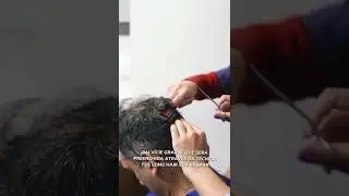 TRANSPLANTE CAPILAR de FIOS LONGOS