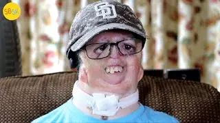 The Return of Jeff (Nager Syndrome)