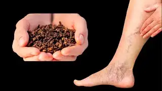 Incredible! 😲 This Remedy Destroys Varicose Veins! Say Goodbye to Them Forever!