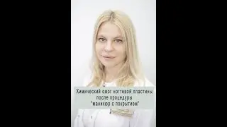 Химический ожог ногтевой пластины после процедуры "маникюр с покрытием"