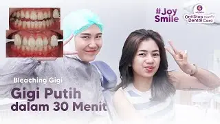 MAU GIGI PUTIH SECARA INSTAN ? YUK LIHAT PROSES BLEACHING GIGI DI JOY DENTAL