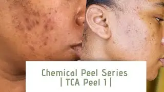 Chemical Peel 1 | Progress and Update on Hyperpigmentation |  Chemical Peel Before & After