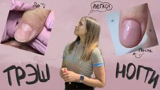 Преображение ТРЭШ ногтей | Как работать со сложной кутикулой