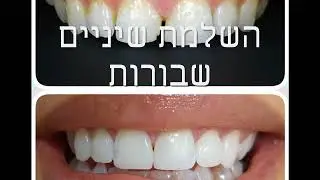 יישור שיניים ד