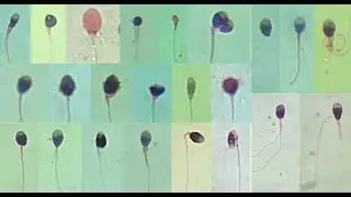 Semen Analysis Test Lab | Sperm Morphology
