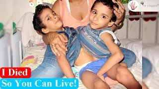 Conjoined Twins: Separation was the Biggest Mistake! ~Body Bizarre!