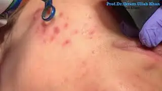 Ditch the Creams! This Laser BLASTES Away Stubborn Acne #acneremoval #lasertreatment