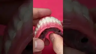 Implants removable dentures!