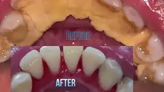 TARTAR REMOVAL AND TEETH CLEANING
