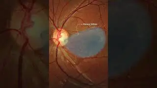 Optic disc pit maculopathy