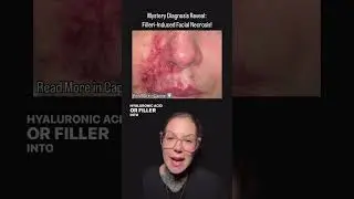 Mystery Diagnosis REVEAL - Filler-Induced Facial Necrosis!