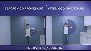 Cured Frozen Shoulder Pain!