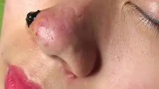 Acne Treatment Blackhead Extractions Popping #84
