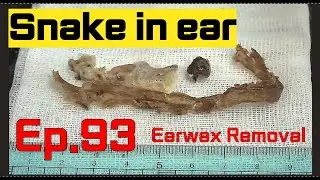 Ep. 93 Earwax removal (Korean ENT doctor “King of earwax”) 귀지형의 Ep.93 귀지제거