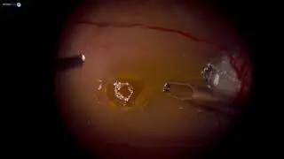 Surgery: Optic Nerve Pit with CSR: Dr. Manish Nagpal