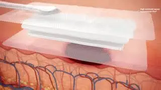 PICO Mechanism of Action - Open Wounds