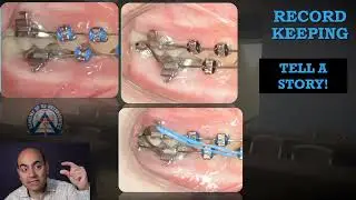 Monday Tip: Bracket 2nd Molars to Level the Curve of Spee