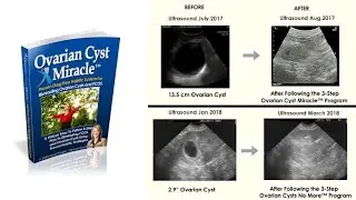 Heal Ovarian Cysts and PCOS Naturally & Success Stories
