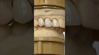 3-Unit Amber Press Crowns @EnvisiontecMain #envisiontec #lsk121shorts #dental #teeth