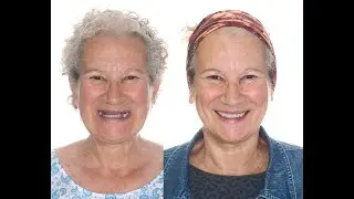MA. PILAR: bone regeneration, zygomatic implants and conventional implants with fixed prosthesis