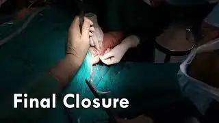 Accurate Arm Lift Surgery with Best Plastic Surgeon in Vesu, City light, Pipod, Surat.