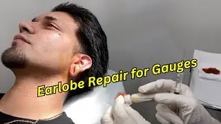 Earlobe Repair for Gauges