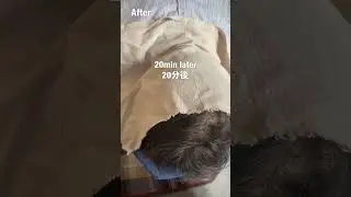 Bulbar ALS trial result