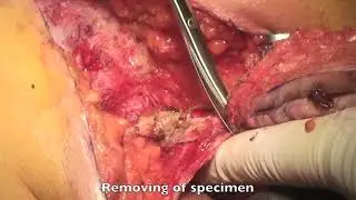 Excision of Extensive Recurrent Pilonidal Cyst with Gluteus Muscle Fascia Plasty & Mid-line Closure