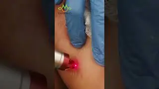 Laser Treatment for Spider Veins