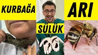 Hacamat - Sülük - Arı Sokturma - Kurbağa - Salyangoz - Karınca - Kurtcuk Tedavisi/Dr. Seyfeddin Esed