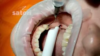 The last appointment with dental implants - fixation of crowns
