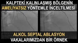 ALKOL SEPTAL ABLASYON | Hipertrofik Kardiyomiyopati Tedavisi