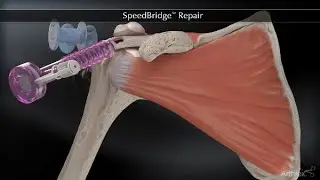 SpeedBridge™ Repair