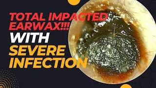 TOTAL Impacted Earwax With SEVERE Infection