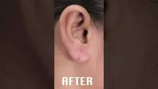 ear hole repair home remedy | ear hole repair cream | ear sticking lotion #earholerepair #piercing