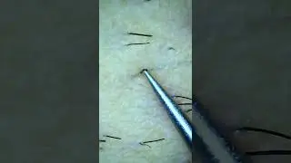 Ingrown Hair Super Zoom 