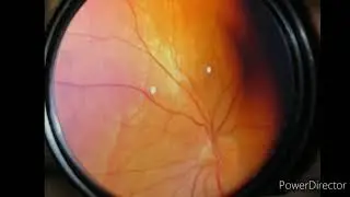 How to calculate CD ratio in glaucoma