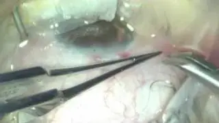 Cataract and Glaucoma Surgery: Micro-incision phaco-trabeculectomy by Dr. Shawn Cohen