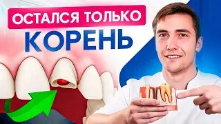Как восстановить зуб, если от него остался только корень?