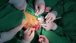 Scrotal Reconstruction | @dr.bobrambe