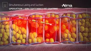 Liposuction, Skin Tightening & Fat Grafting - Lipo Life by Alma Lasers (Medical Device 3D Animation)