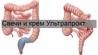 Свечи и крем Ультрапрокт
