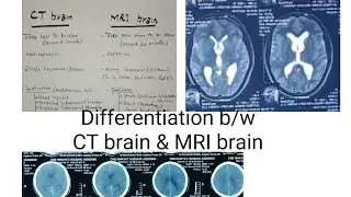 Differentiation between CT Brain and MRI brain