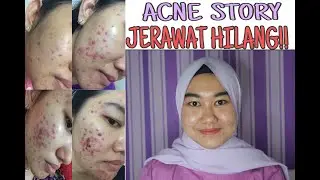 [ACNE STORY PART II] FINALLYYY JERAWAT TERHEMPASKAN, KULIT MUKA MEMBAIK !!