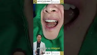 From Dentures to a Confident Smile with Fixed Implants