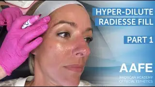 Hyperdilute/Dilute Radiesse Fill Pt.1