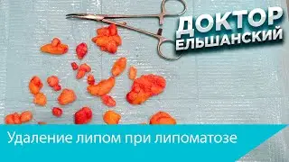 Удаление липом при липоматозе